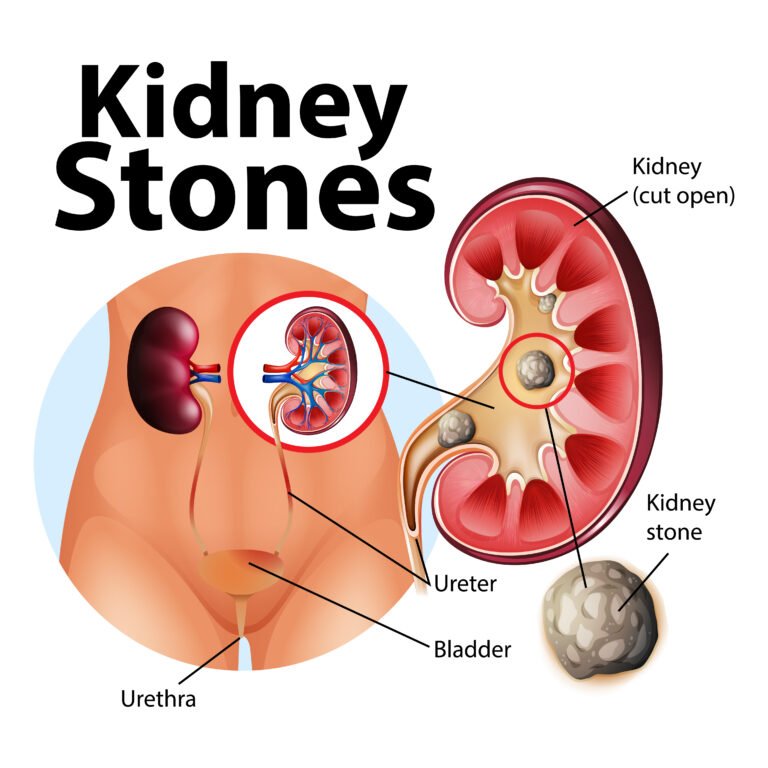 Kidney Stone